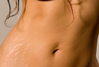 stretch_marks