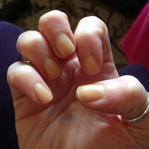 ugly nails