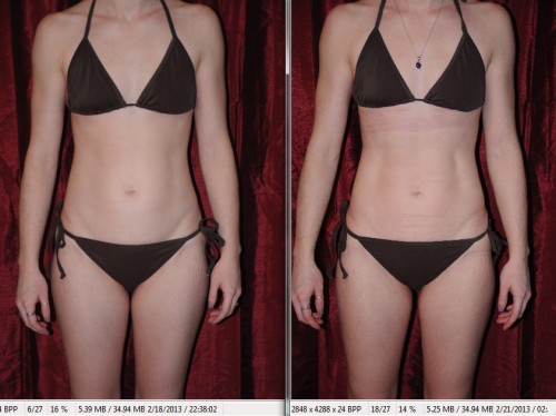 i-lipo before and after