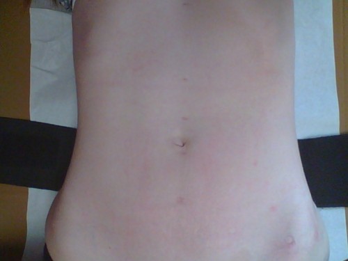 my tummy right after the treatment