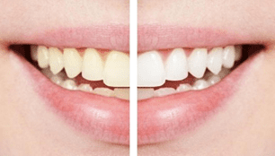 white teeth 01