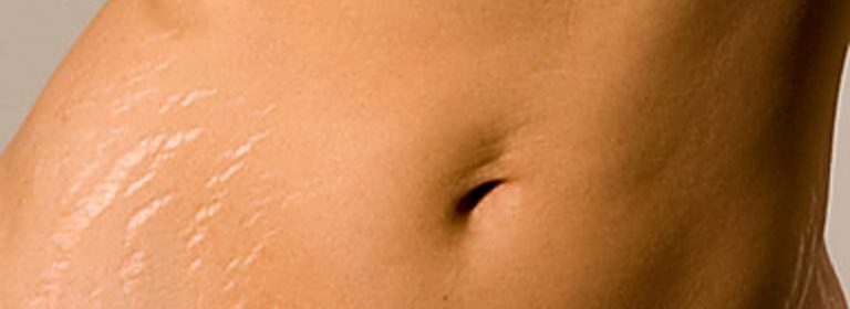 Gold Collagen vs Skinade – Secret Weapon Against Stretch Marks