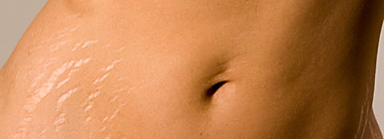 Gold Collagen vs Skinade – Secret Weapon Against Stretch Marks