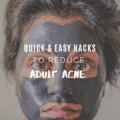 Quick & Easy Hacks To Reduce Adult Acne