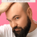 4 Reasons To Consider Getting a Hair Transplant