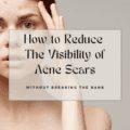 How to Reduce the Visibility of Acne Scars