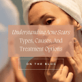 Understanding Acne Scars: Types, Causes, And Treatment Options