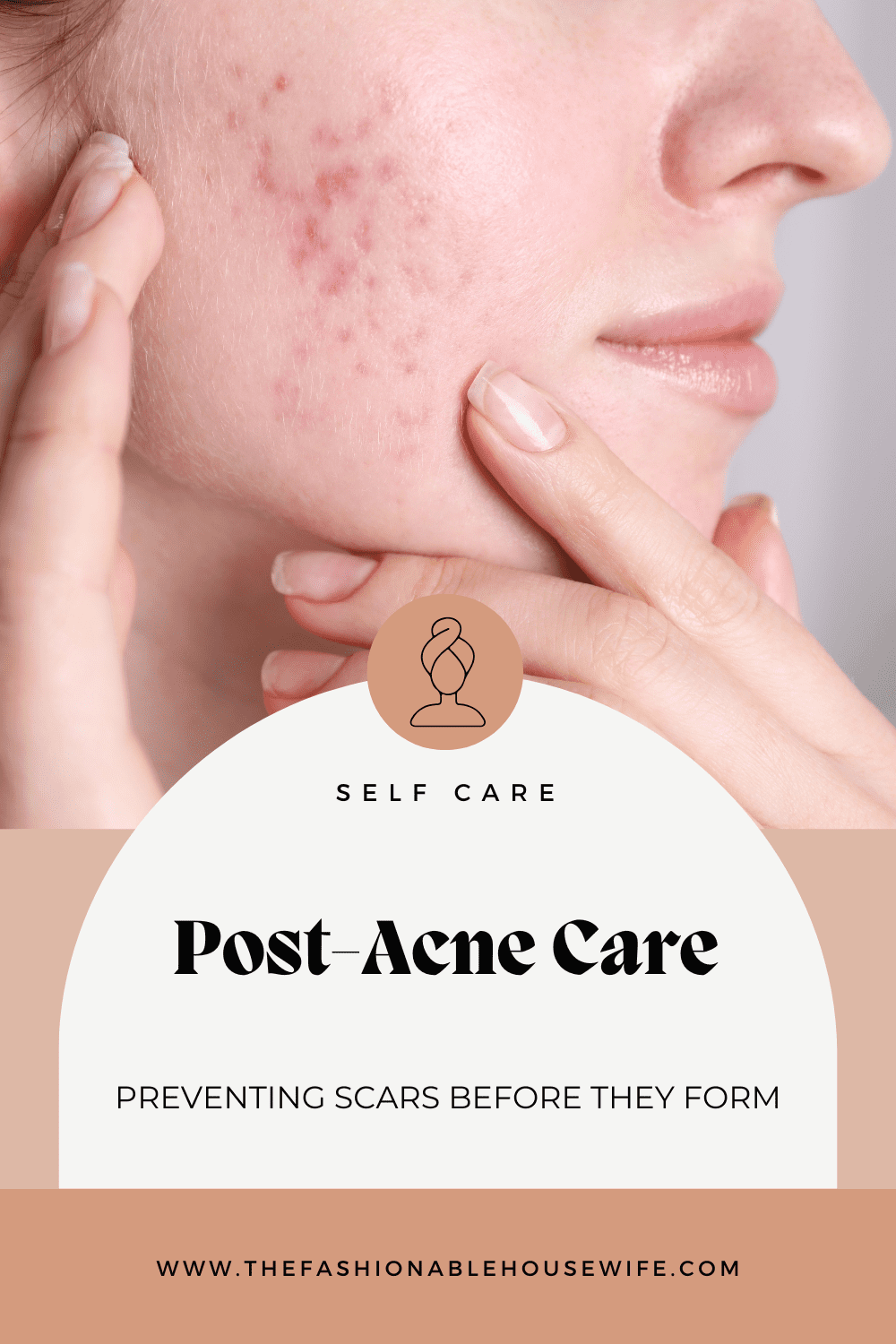Post-Acne Care: Preventing Scars Before They Form