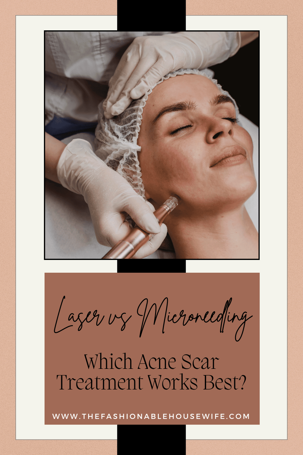 Laser vs Microneedling: Which Acne Scar Treatment Works Best?