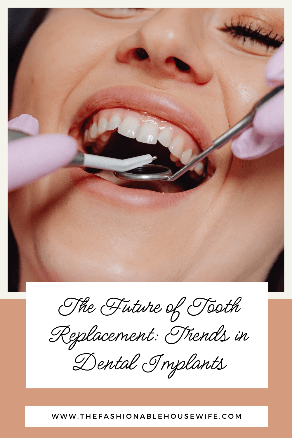 The Future of Tooth Replacement: Trends in Dental Implants