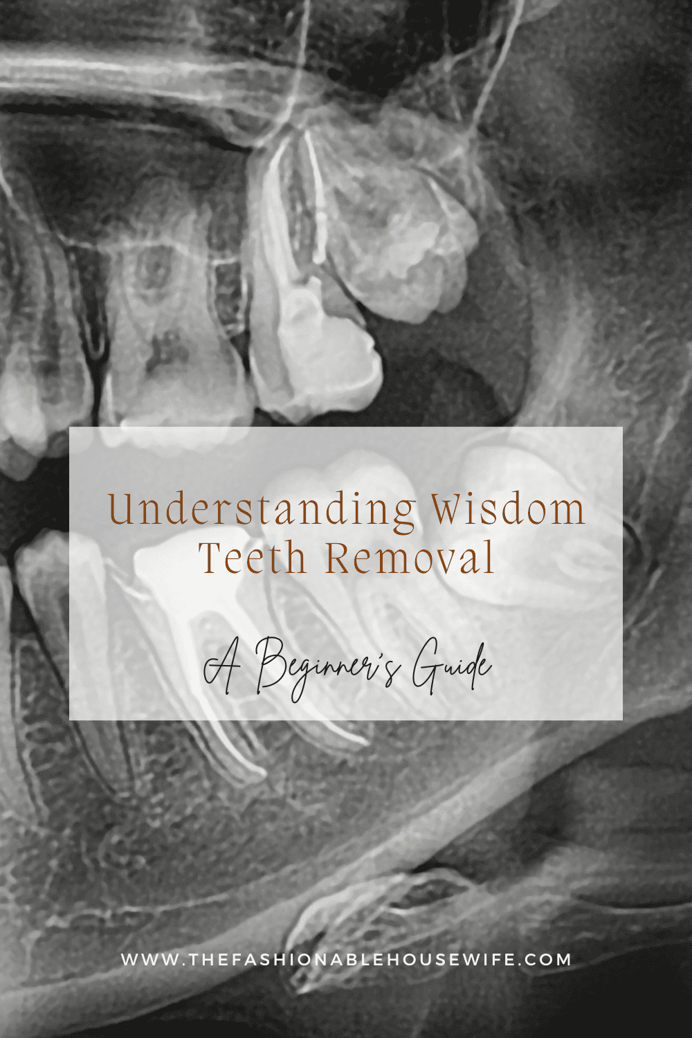 Understanding Wisdom Teeth Removal: What to Expect Before, During, and After